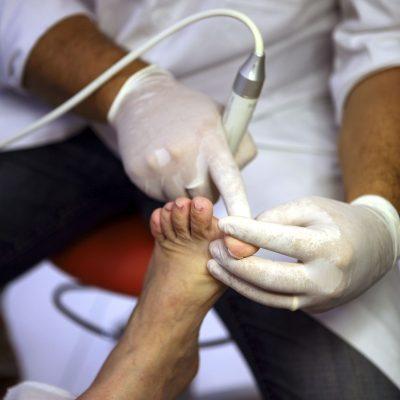 Tratamiento de hongos con láser – onicomicosis